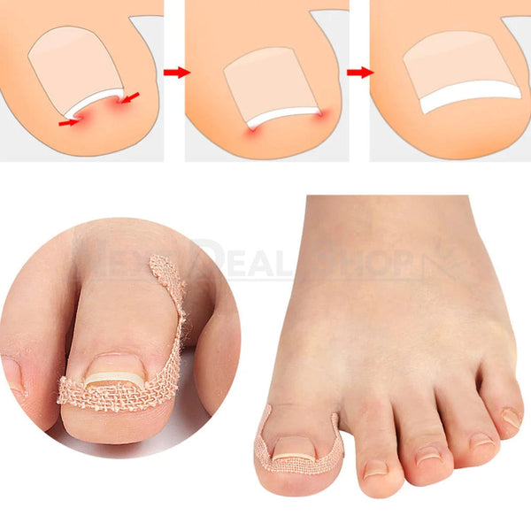 20 Pcs Ingrown Nail Correction Bandage