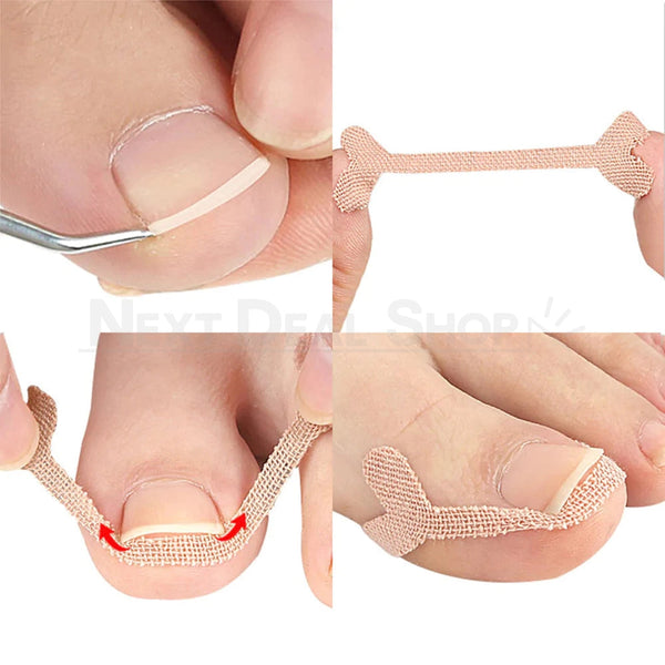 20 Pcs Ingrown Nail Correction Bandage